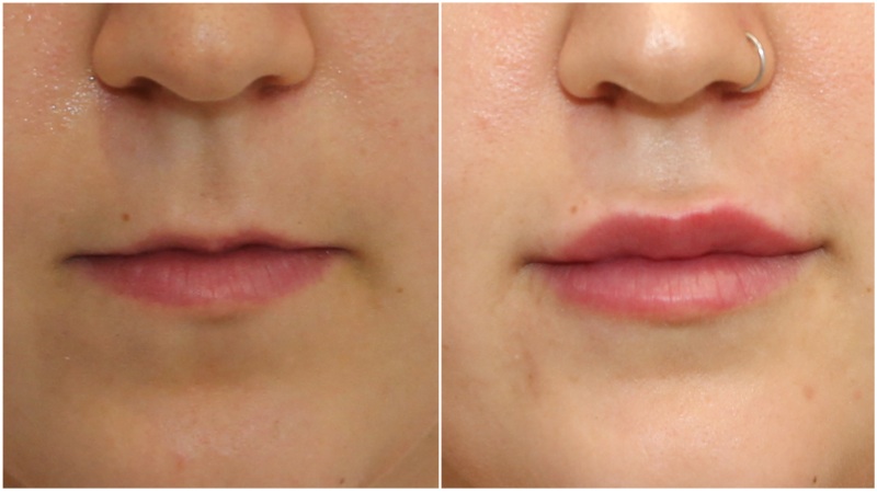 Lip balance achieved using hydrating lip filler