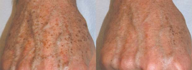 Hand rejuvenation following a series of 3 Optimised light treatments to remove pigmentation and age spots