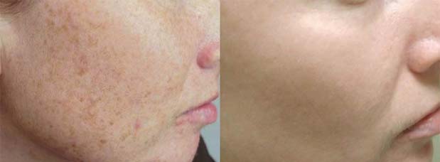 Optimised light treatments have been used over the full face to decrease the signs of sun damage and to even the skin tone, the patient received 3 treatments in total