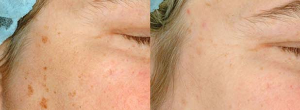 Optimised light has been used to decrease the signs of age spots, the patient received only 1 treatment