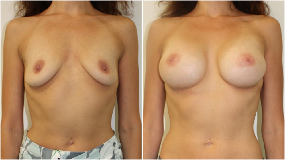 Breast Re-inflation by Dr Miroshnik, using 410g anatomical, cohesive gel implants, dual-plane positioned