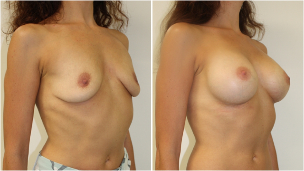 Breast Re-inflation by Dr Miroshnik, using 410g anatomical, cohesive gel implants, dual-plane positioned