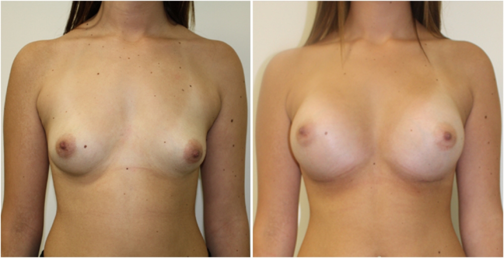 18 yo female, dual-plane 2 submuscular breast augmentation, 350cc textured round breast implants, A cup -> D cup.