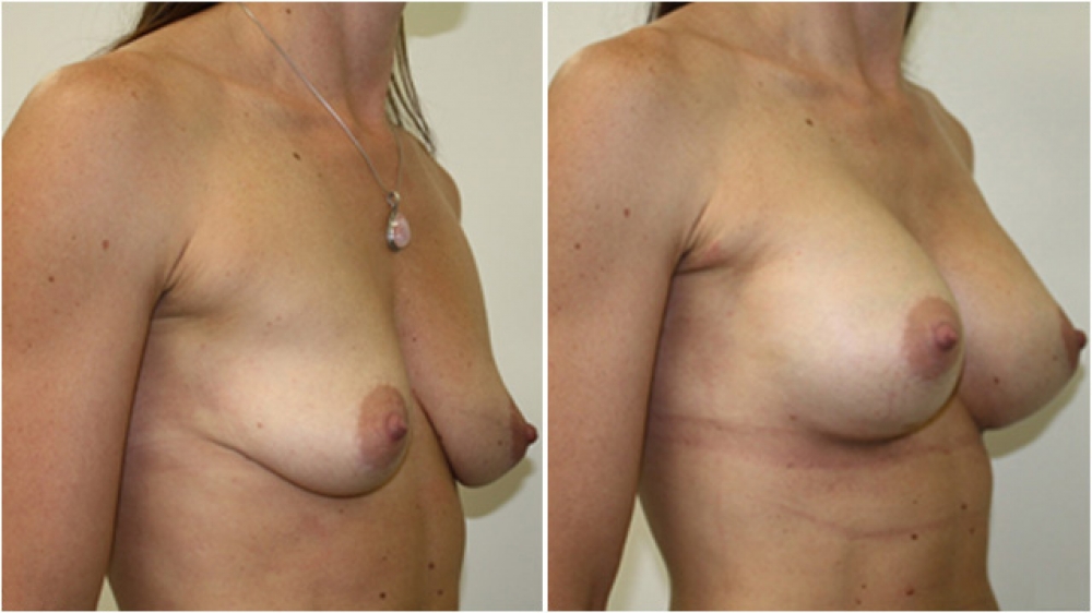 Breast augmentation by Dr Miroshnik to correct significant breast droop (without a lift) using 310g anatomical implants