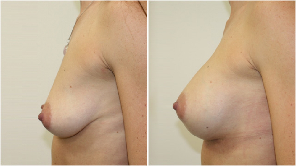 Breast augmentation by Dr Miroshnik to correct significant breast droop (without a lift) using 310g anatomical implants