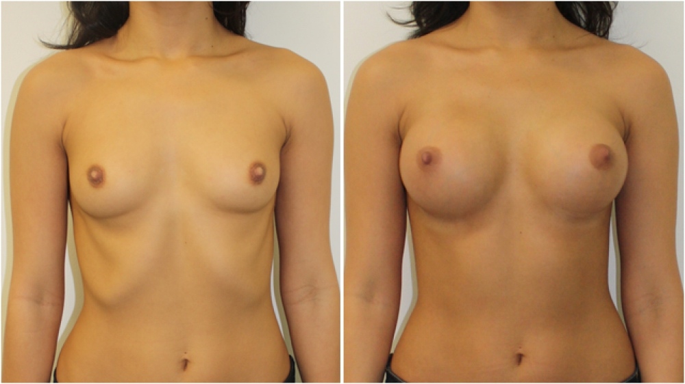 Enhanced style look created on a small framed patient with dual plane-positioned 215cc, high profile implants.