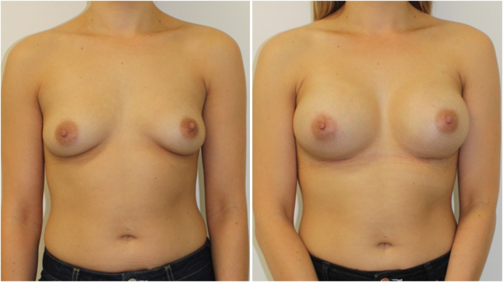 20s, no children, 290 g anatomical (teardrop) moderate profile implants, dual plane 3 placement. A -> C cup.