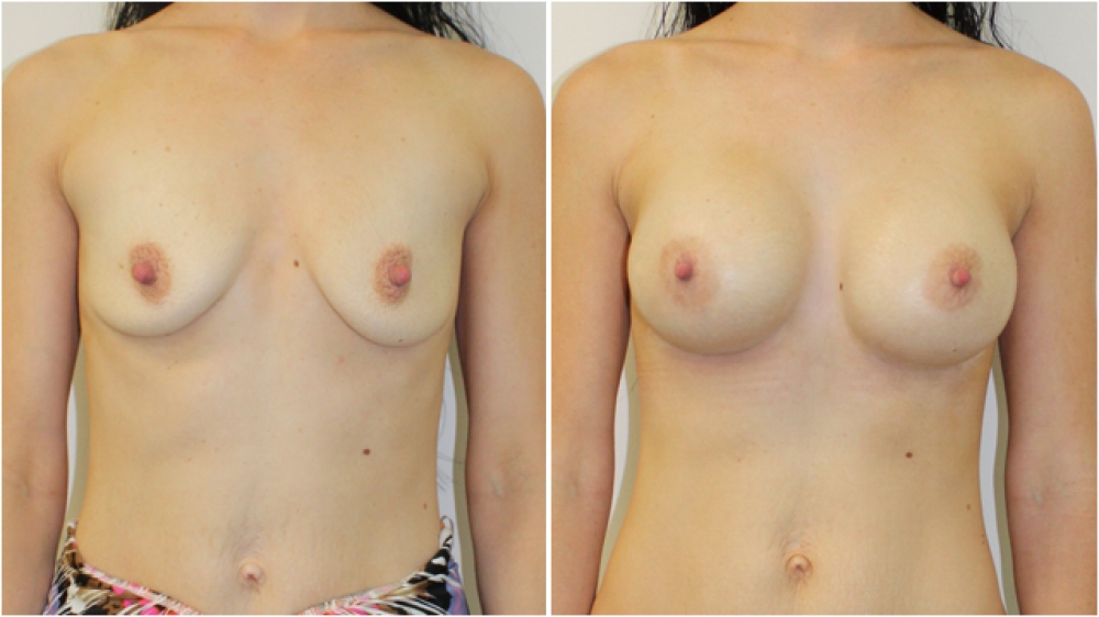 Breast augmentation to correct drop using 360g, extra high profile implants, dual-plane positioned