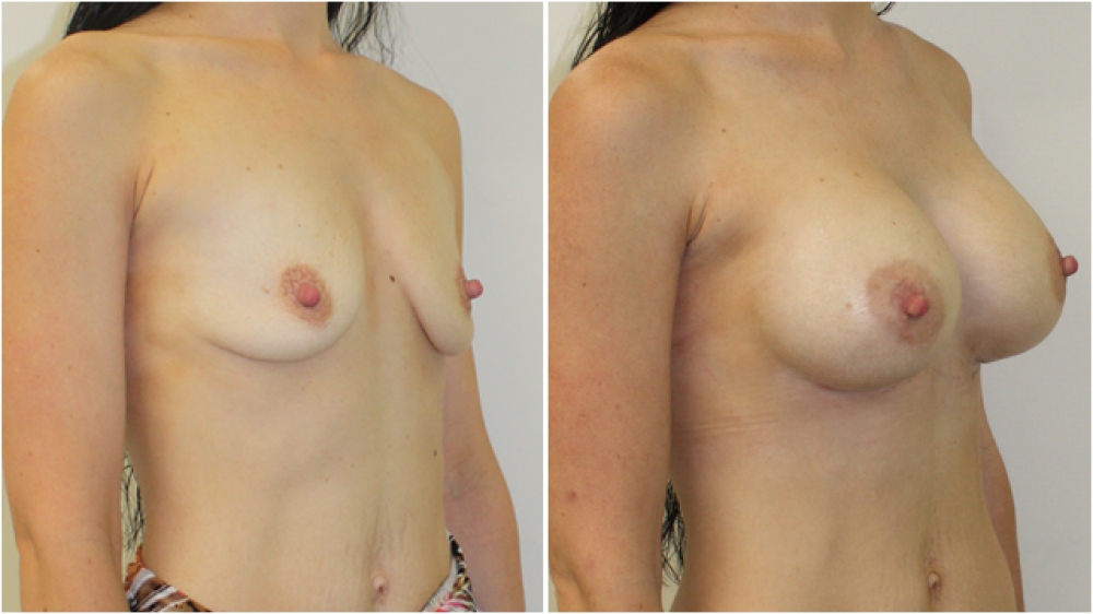 Breast augmentation to correct drop using 360g, extra high profile implants, dual-plane positioned