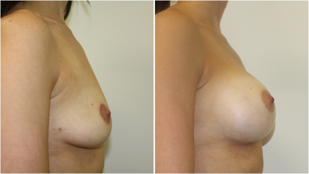 Breast augmentation by Dr Miroshnik to correct droop using dual-plane positioned 295g, high profile implants