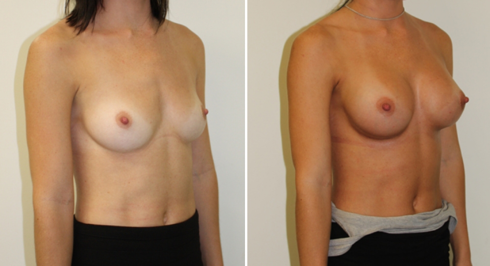 Natural style breast augmentation by Dr Miroshnik using 315g, anatomic, dual-plane placed implants.