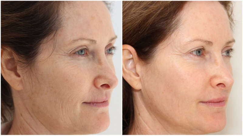 Wrinkle reduction and skin texture improvement using a course of fractional laser technology