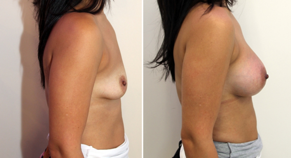 Breast Re-inflation by Dr Miroshnik using 390g anatomic implants, subfascial placement