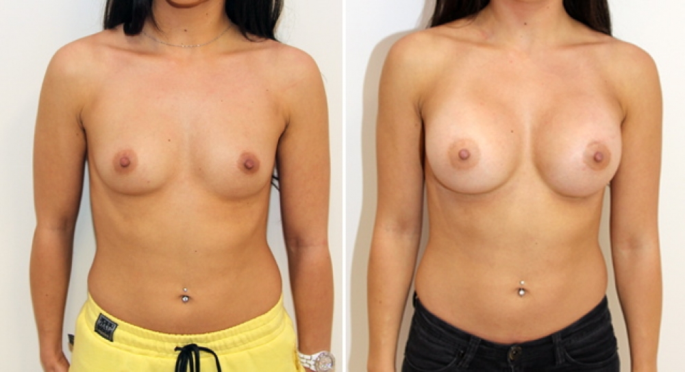 Mid 20s, no children, breast augmentation performed using 345g round implants with dual plane 2 placement.