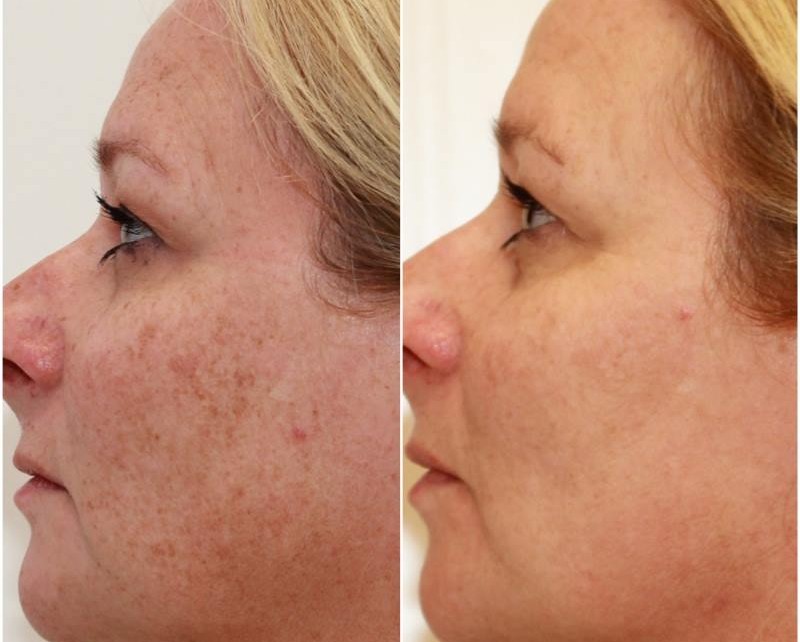 Optimised light treatments have been used over the full face to decrease the signs of sun damage and ageing pigmentation, the patient received 3 treatments in total