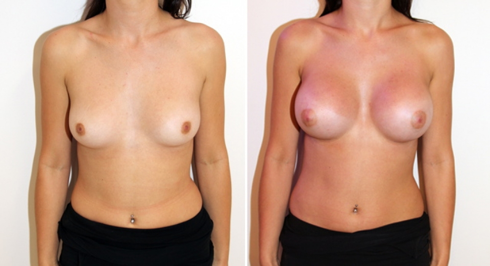 Early 20's, no children, bilateral breast augmentation performed using 350g, round implants, with dual plane 2 placement.