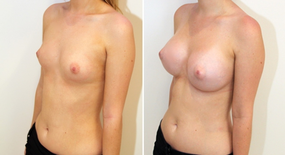 Natural style breast augmentation by Dr Miroshnik using 390g, high profile, round implants, dual plane placement.