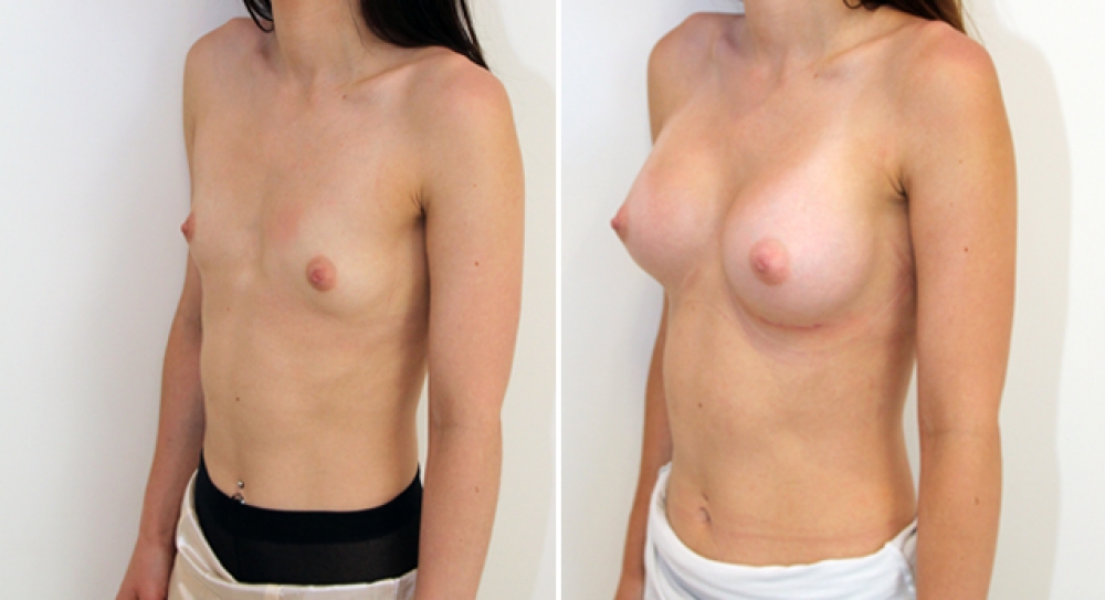Natural style breast augmentation by Dr Miroshnik using 255g anatomical (teardrop) implants, submuscular placement