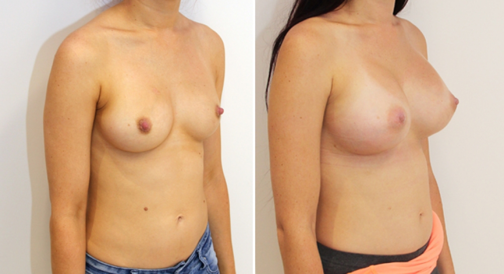 30yo, 2 children, breast augmentation performed using 470g anatomical implants (teardrop) with dual plane 2 placement.