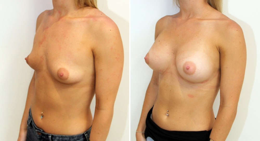 Breast augmentation by Dr Miroshnik to correct droop using 360g, anatomical implants, dual-plane positioned