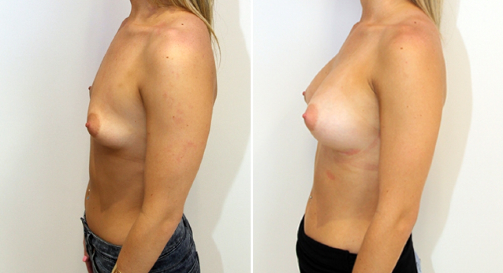 Breast augmentation by Dr Miroshnik to correct droop using 360g, anatomical implants, dual-plane positioned