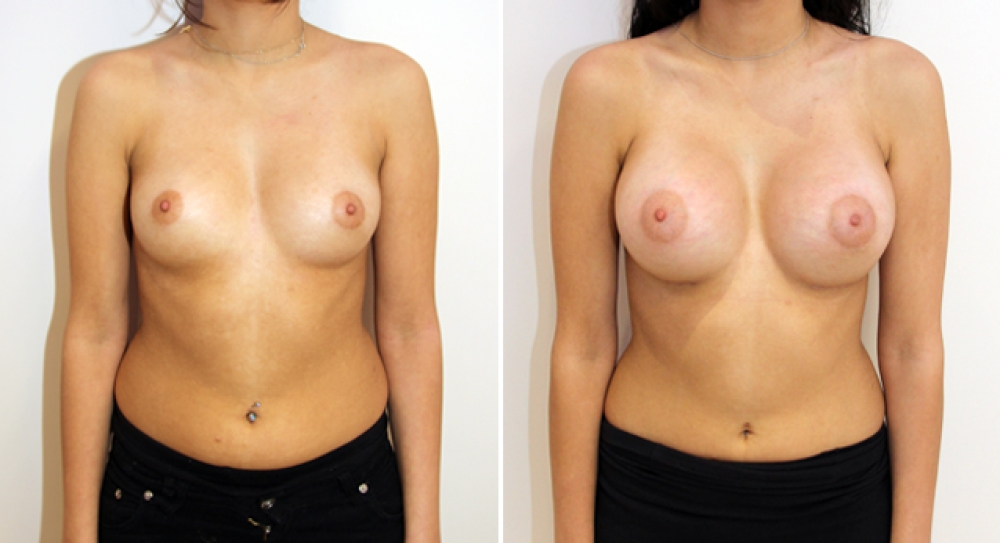 Enhanced look created here with the use of high profile, 345g round style implants.