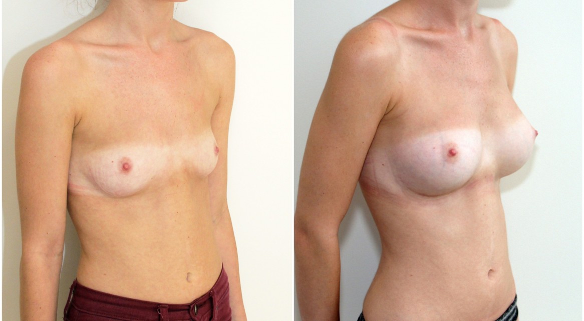 20s, 315g, moderate profile, anatomical (teardrop), dual plane 1 submuscular placement.
