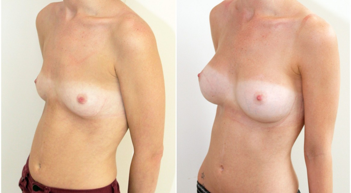 20s, 315g, moderate profile, anatomical (teardrop), dual plane 1 submuscular placement.