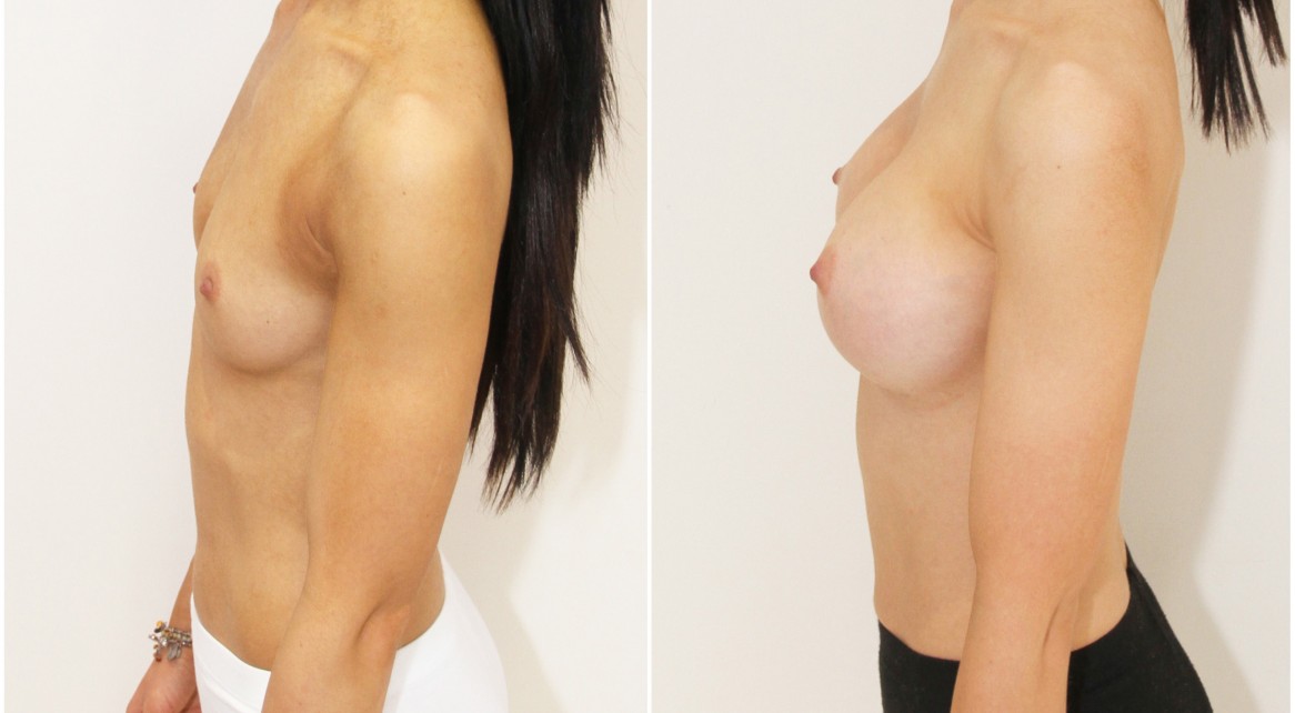 Natural style augmentation by Dr M with 330cc anatomics, dual plane.