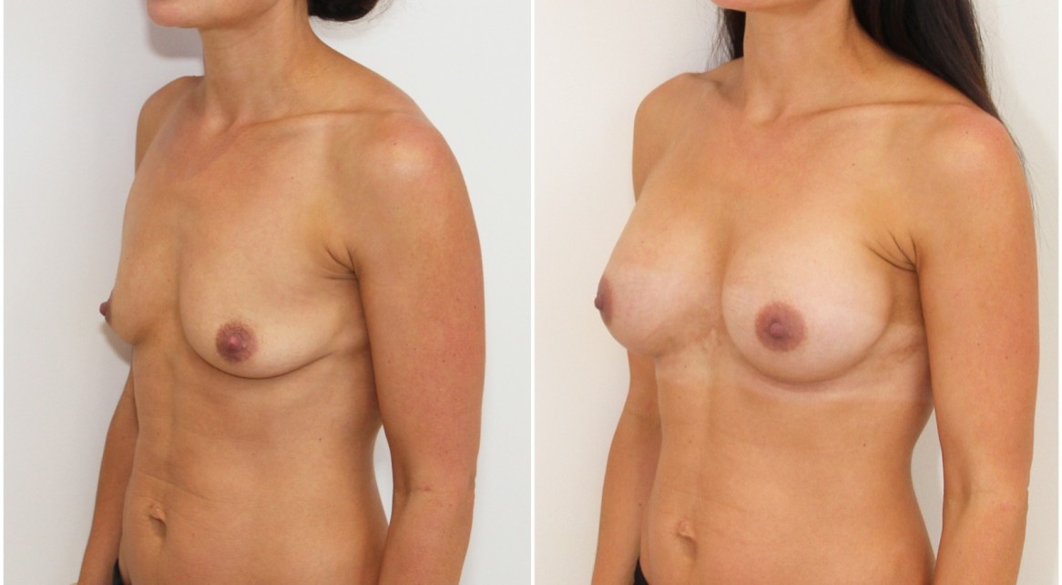 Droop correction with 330cc anatomical implants, dual plane positioned.