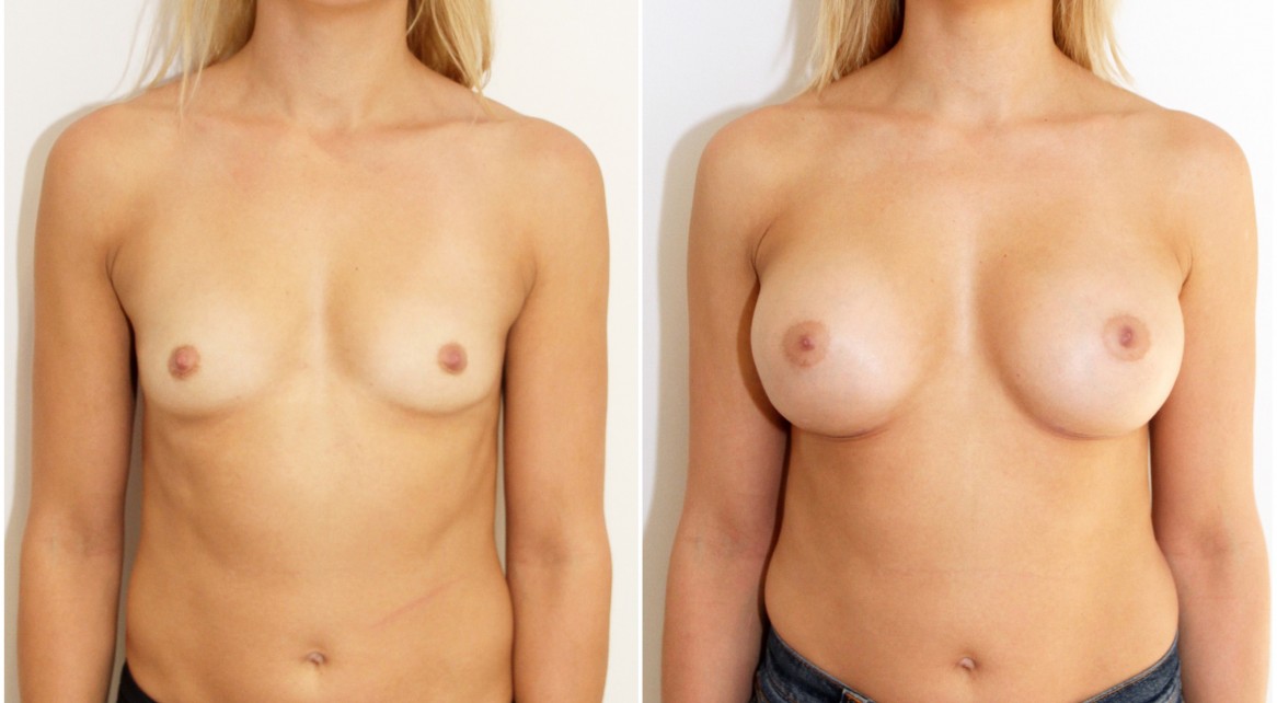 20s, 330cc mod plus profile anatomical implants, dual plane 2.