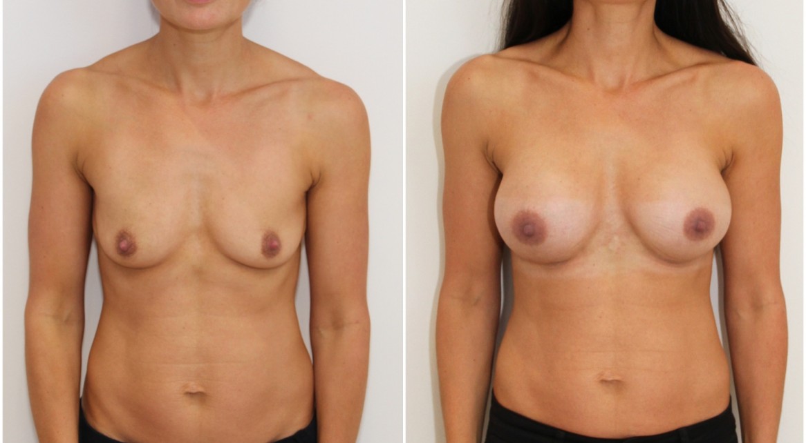 Droop correction with 330cc anatomical implants, dual plane positioned.