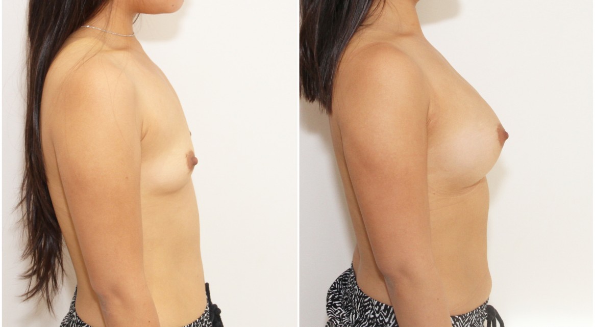 20s, 330g, dual plane 1, anatomical implants, memory shape gel.