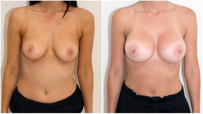 Enhanced-style look achieved by Dr Miroshnik with the use of 375g, high profile, anatomical implants