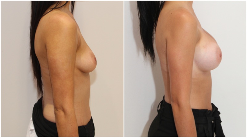 Enhanced-style look achieved by Dr Miroshnik with the use of 375g, high profile, anatomical implants