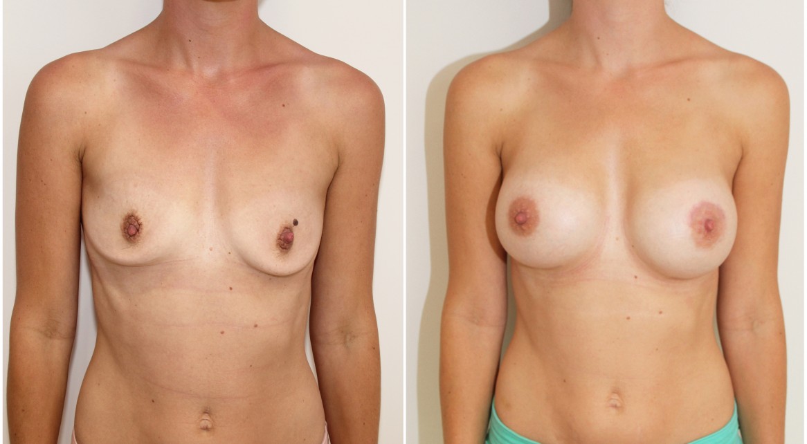 Droop correction with dual-plane positioned, 420g CPG anatomical implants.