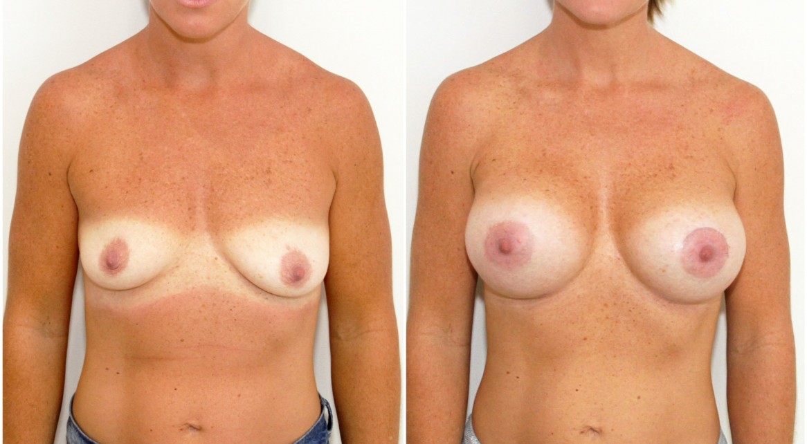 30s, 440cc high profile, anatomical, dual plane 3 positioned, peri-areolar crescent lift on the left breast to correct symmetry.