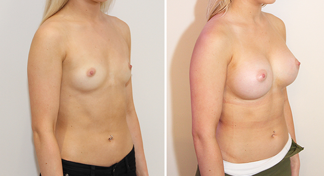 Natural style augmentation with round, 390g, high profile implants, dual plane 2 positioned.