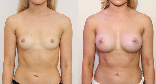 Natural style augmentation with round, 390g, high profile implants, dual plane 2 positioned.