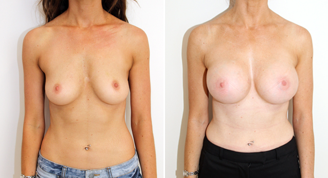 Enhanced style augmentation with 350cc, dual plane positioned, round implants.