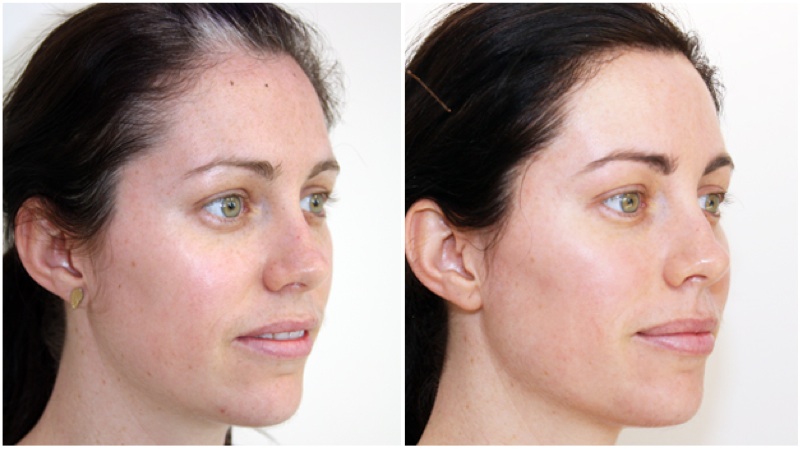 Optimised light treatments have been used over the full face to decrease the signs of sun damage and to even the skin tone, the patient recieved 3 treatments in total