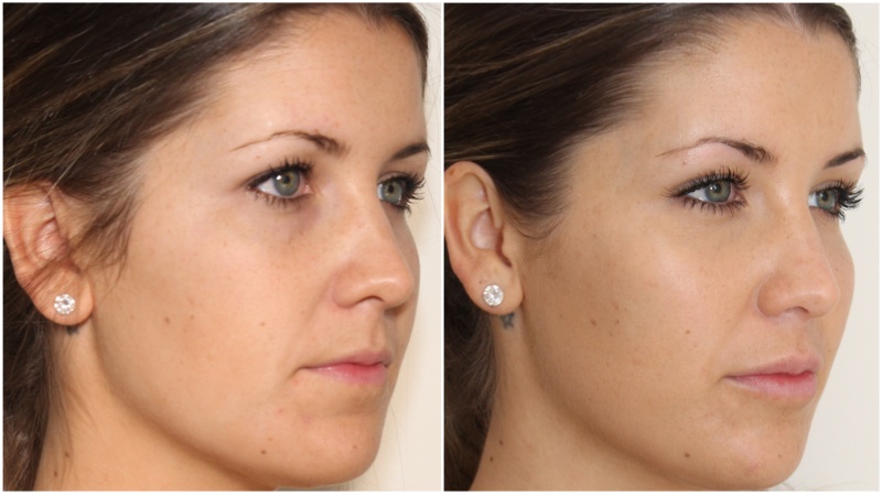 Volumising dermal fillers used in the cheeks to enhance projection, hydrating dermal filler used to soften under eye hollowing and to enhance the lips. Anti-wrinkle injections used to the upper face to lift the brow and soften fine lines on the forehead and frown