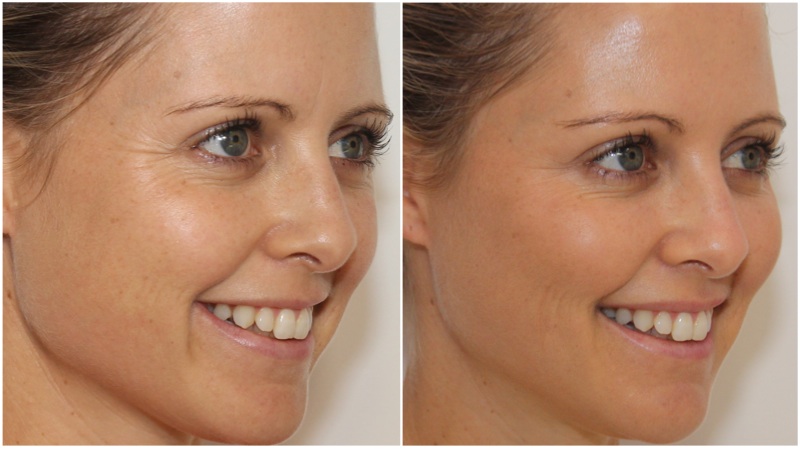 Volumising filler used to enhance the cheeks and soften the smile lines, Anti wrinkle injections used to soften the upper facial lines and slim the jawline