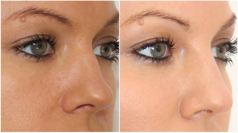 Hydrating dermal filler used to refine and straighten the bridge of the nose