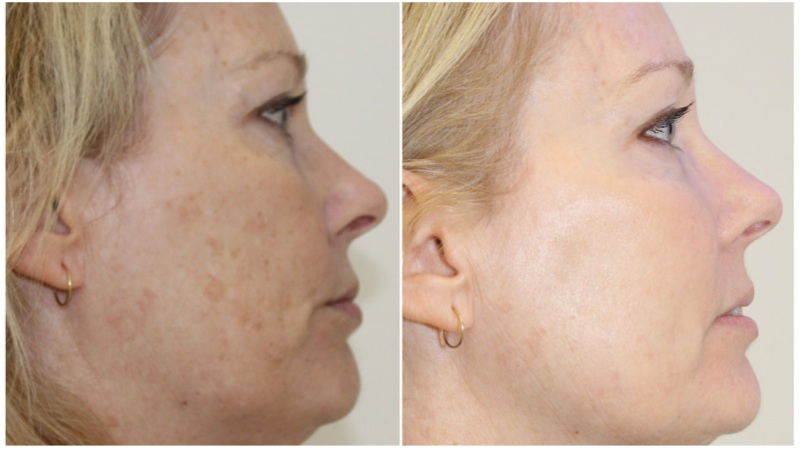 A course of 3 optimised light treatments for age spots, pigmentation and vascular lesions