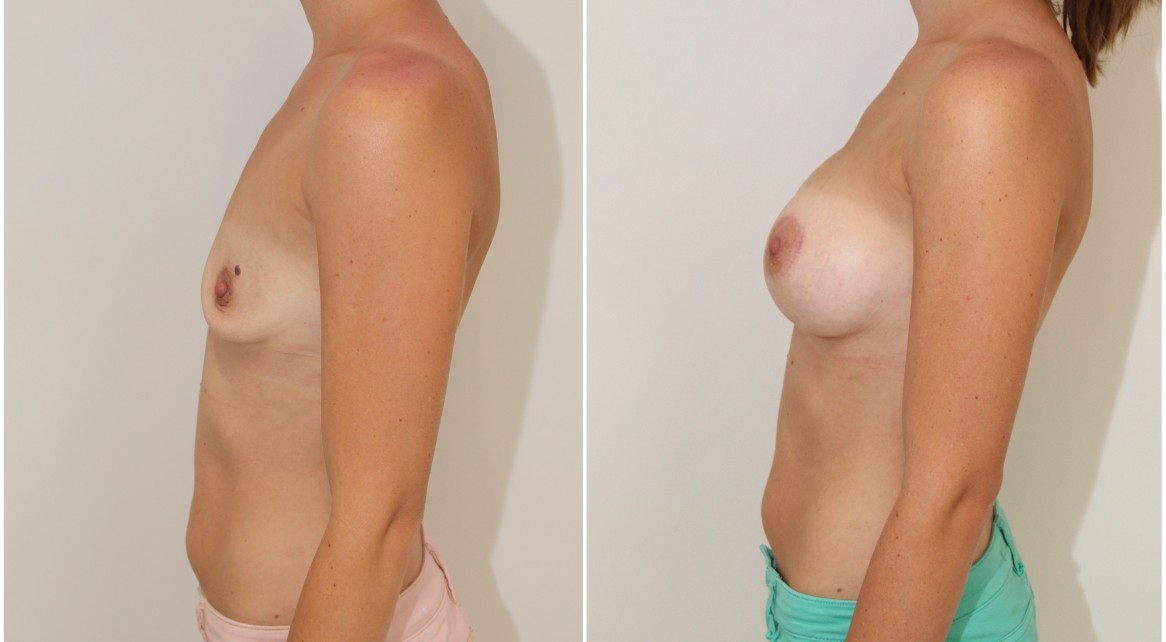 Droop correction with dual-plane positioned, 420g CPG anatomical implants.
