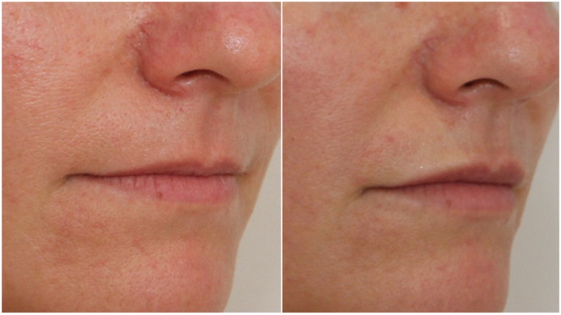 Subtle lip enhancement achieved using hydrating lip filler