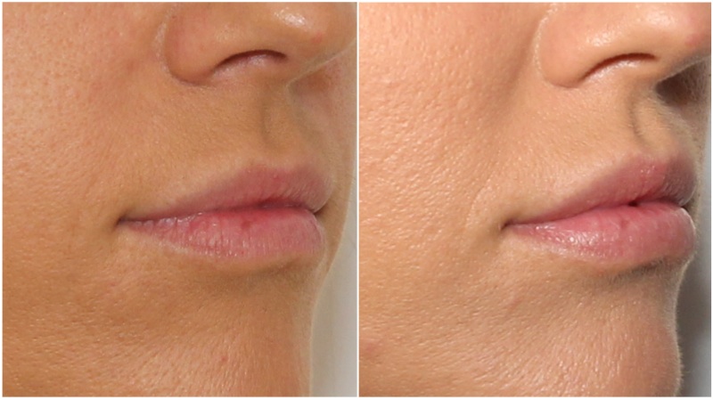 Lip enhancement achieved using hydrating lip filler