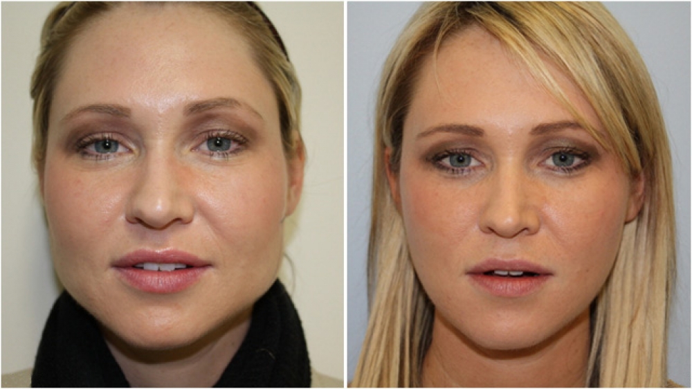 Jawline definition and cheek projection changed using a combination of anti-wrinkle injections to the jawline and enhancing the cheek bone and mid face region