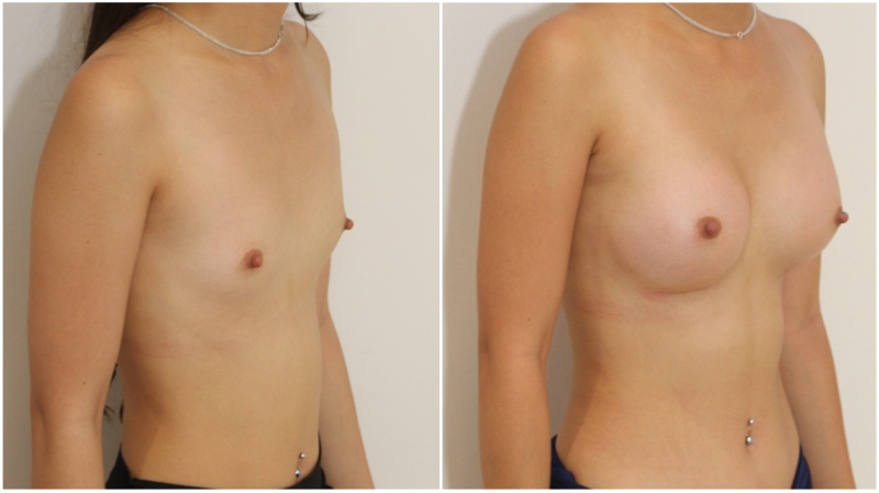 AA cup, minimal breast to start with, shape created with 255g anatomicals, dual-plane placed.